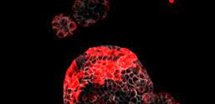 Científicos descubren las células malignas responsables de la recaída en el cáncer de colon